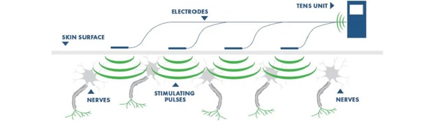 Transkutánní elektrická nervová stimulace (TENS) – co je to a na co ji použít?